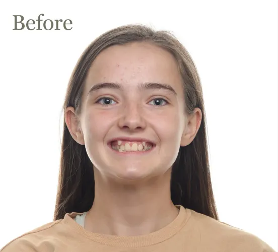 teeth-alignment-73da6f57-500h teeth-alignment-73da6f57-500h