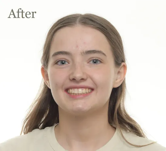 teeth-alignment-c2321e3a-500h