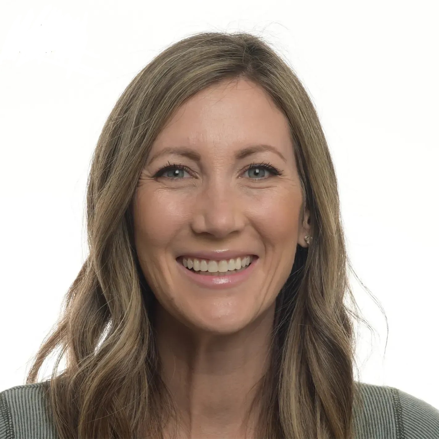 After Gummy Smile Edit