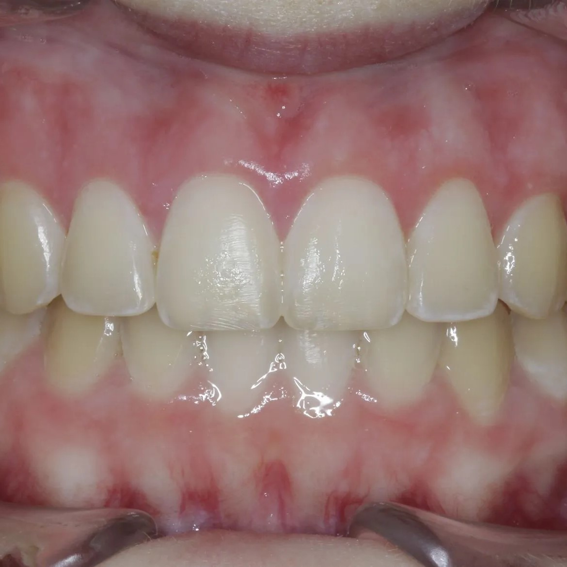 Contouring Work Case 1 Final Close Edit