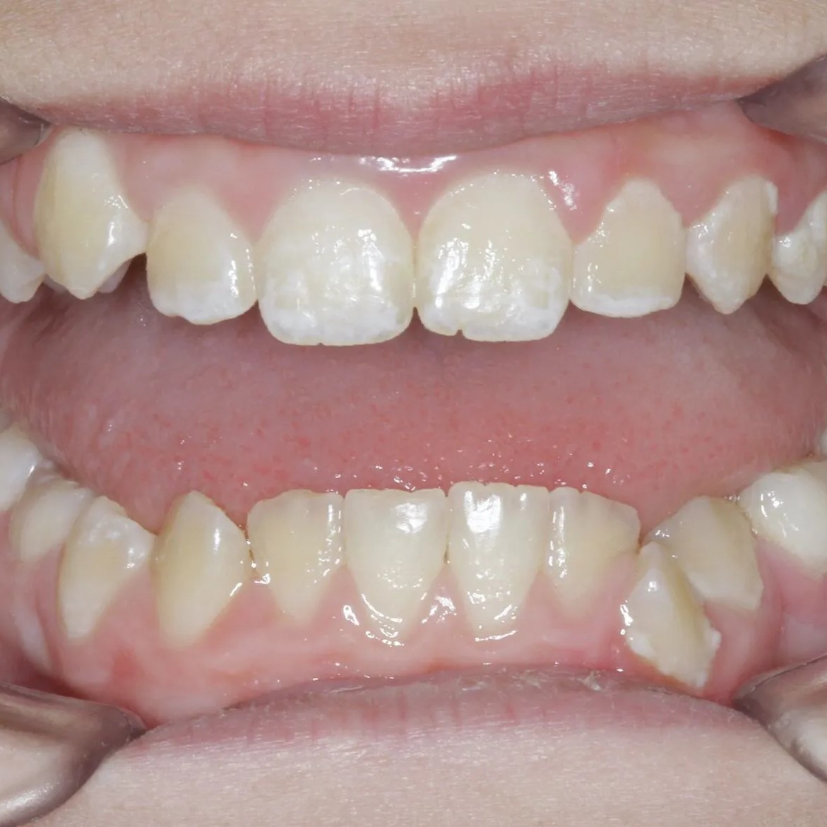 Contouring Work Case 1 Initial Open Edit