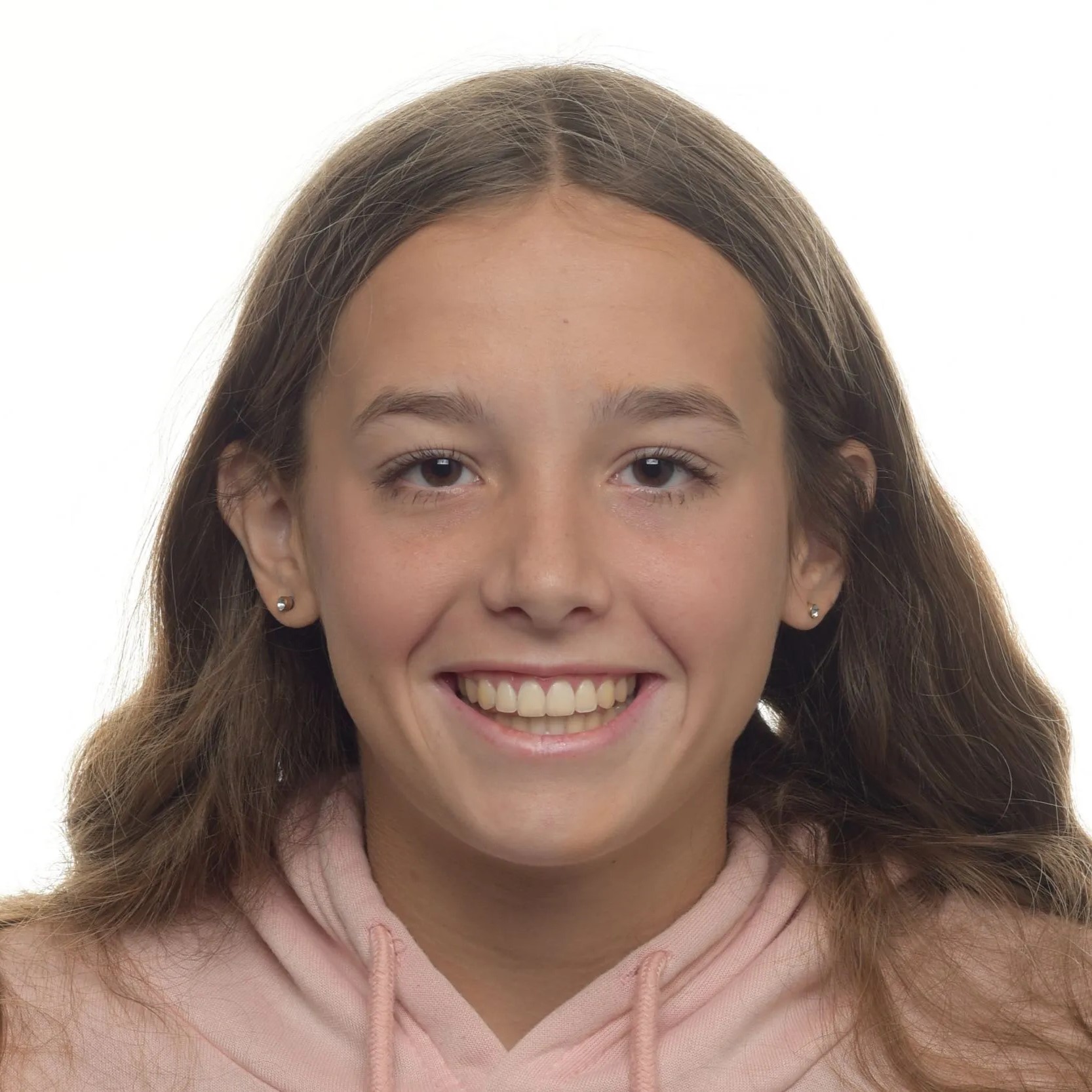 Final Gingivectomy Edit